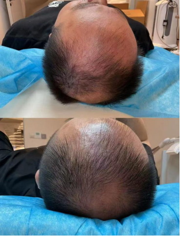 外泌体生发 外泌体生发